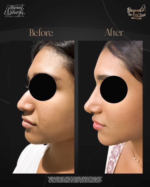 أفضل دكتور لمتابعة ما بعد عملية الأنف في الرياض